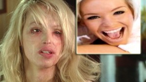 Acid+attack+model+katie+piper