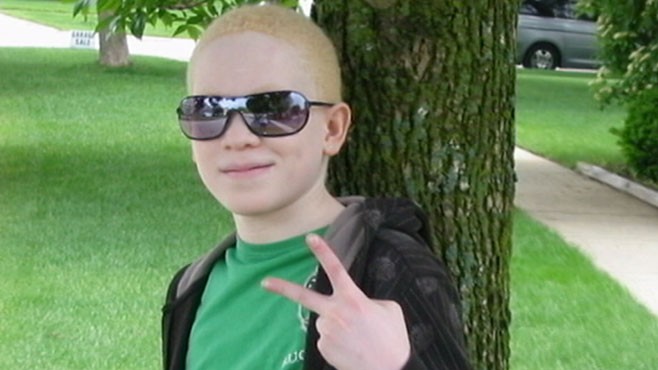 Video: Albinism: Life Outside the Mainstream
