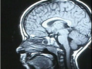 MRI