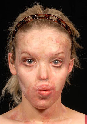 Photo: British model Katie Piper was brutally burned when a stranger threw sulfuric acid in her face.