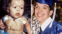 Photo: Boy Born With Heart Outside Body Defies Odds: He's got such a good heart. It might be on the outside but it's a good heart."