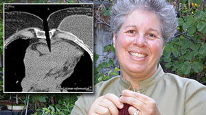 Photo: near-fatal impalement with knitting needles