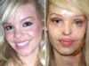 Model Burned in Vicious Sulfuric Acid Attack