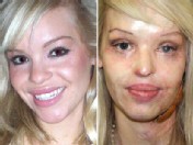 Model Burned in Vicious Sulfuric Acid Attack