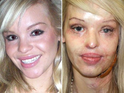 burn victims face before and after