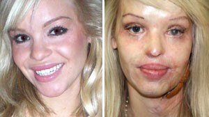 Acid+attack+model+katie+piper