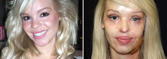  capture a complete stranger throw sulfuric acid in Katie Piper's face