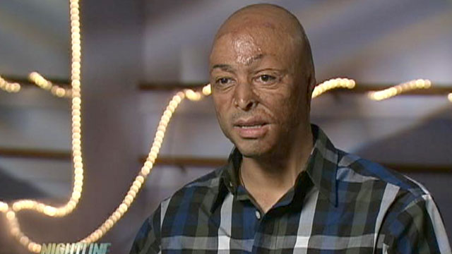 PHOTO: J.R. Martinez was just 19 years old when a bomb hit his Humvee while he was serving as an U.S. Army infantryman in Iraq.