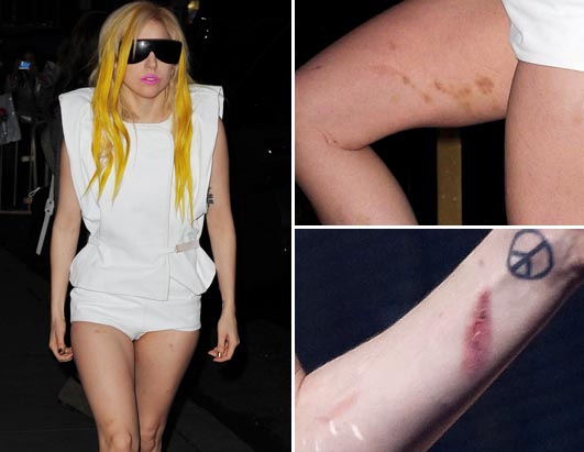 A large inflamed scab under a peace sign tattoo on her arm was clearly 