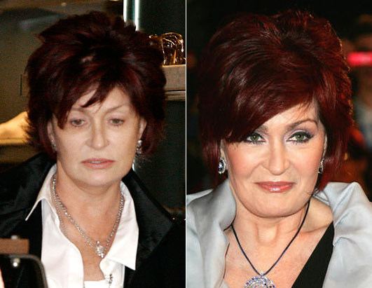 sharon osbourne before surgery