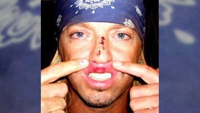 PHOTO: In this image released by Bret Michaels Entertainment, Poison frontman and TV reality star Bret Michaels displays the injuries he received after performing at the Tony awards, June 7, 2009, in New York.