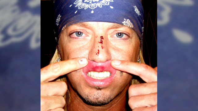 PHOTO: In this image released by Bret Michaels Entertainment, Poison frontman and TV reality star Bret Michaels displays the injuries he received after performing at the Tony awards, June 7, 2009, in New York.