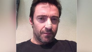 PHOTO: Actor Hugh Jackman posted this photo on his Instagram account on Nov. 21, 2013 with the caption, "Deb said to get the mark on my nose checked. Boy, was she right! I had a basil cell carcinoma."