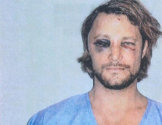 Olivier Martinez Wears Hand Brace