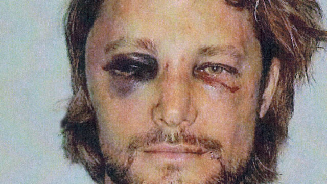PHOTO: These are the brutal injuries Gabriel Aubry claims he suffered at the hands of Halle Berry's fiance Olivier Martinez on Nov. 22, 2012, Los Angeles.