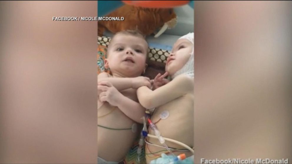 VIDEO: Formerly Conjoined Twins Successfully Separated