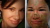 Woman Badly Burned in Acid Attack Still 'Happy'
