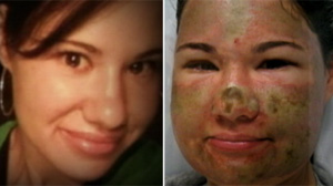 Woman Badly Burned in Acid Attack Still Happy