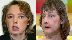 Isabelle Dinoires Journey Since Her Groundbreaking Surgery