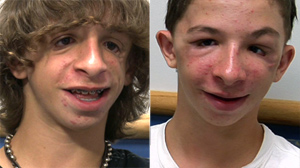 PHOTO Brad Guilkey, 15, who was born without cheekbones, is shown, left, before a surgery to help him grow cheekbones, and after, right.