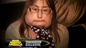 Photo: First U.S. face transplant patient Connie Culp