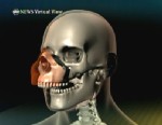VIDEO: Virtual view of partial face transplant.