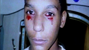 A Boy Bleeds From His Eyes and Doctors Dont Know Why