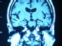 The Fight Against Alzheimer's