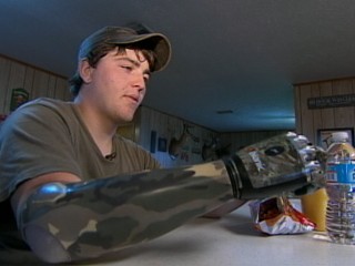Watch: Florida Teen Gets New Arm after 11-Foot Gator Attack