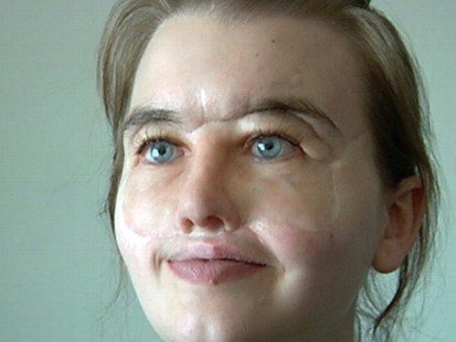 VIDEO: Shot 40 times in the head, Chrissy Steltz received a face transplant.