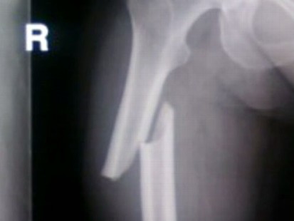 VIDEO: New research suggests that Fosamax could contribute to broken bones.