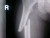VIDEO: New research suggests that Fosamax could contribute to broken bones.