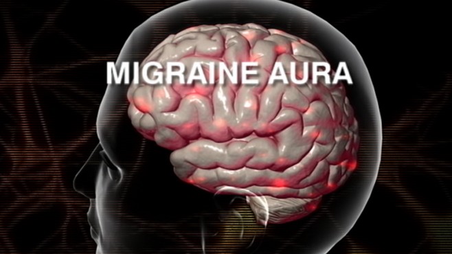 migraine-can-mimic-stroke-video-abc-news