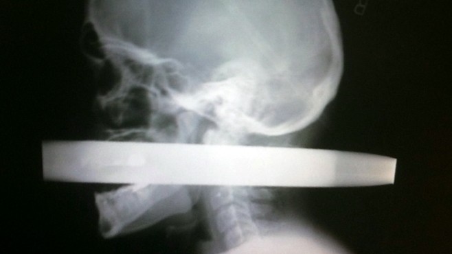 VIDEO: Dr. Richard Besser explains how Andrew Linn escaped death by a few centimeters.