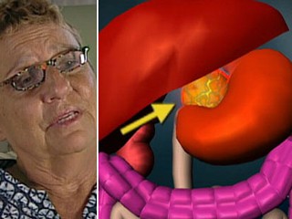 brooke surv tumor