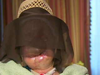 Charla Nash After the Chimp Attack