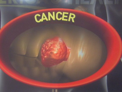 VIDEO: Colonoscopy