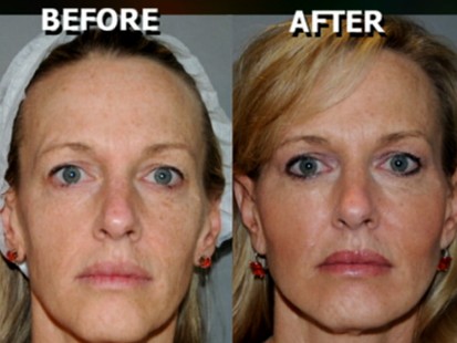 VIDEO: Some older workers are getting cosmetic procedures to compete in job market.