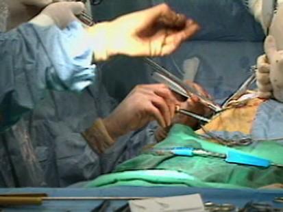 VIDEO: A new method of surgery lets the heart keep beating reduces brain damage risks.