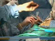 Bypass Surgery: To Beat or Not to Beat