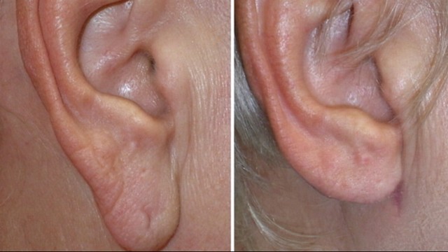 Earring For Fat Earlobes Beautify Themselves With Earrings Earring For Fat Earlobes Large Submited Images