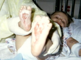 Child with burned feet