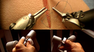 Robotic Surgery Offers Precise Handling, Quicker Procedures