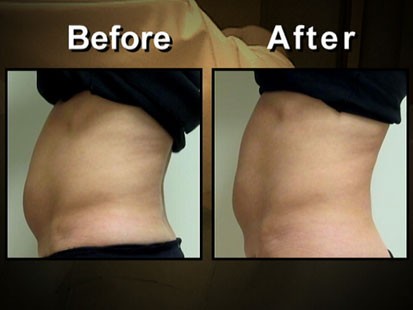 VIDEO: A before and after picture of some ones stomach.