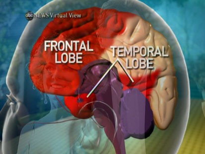 VIDEO: Dr. Jam Ghajar explains the impact the Natasha Richardsons fall had on her brain.