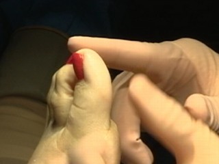 Watch: Extreme Plastic Surgery: Toe-Shortening