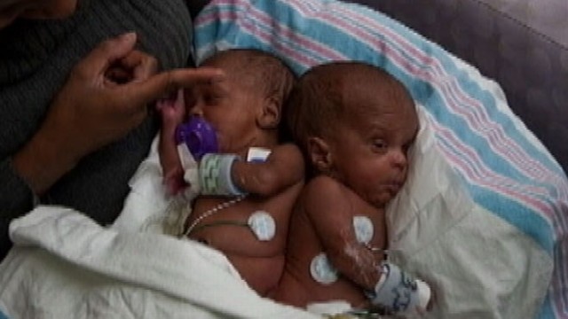 VIDEO: Tennessee hospital performs complex surgery to separate Joshua and Jacob Spates.