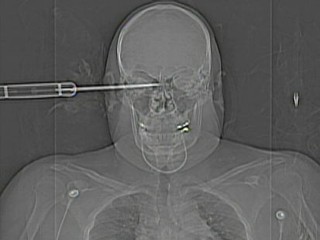 x-ray