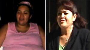 Better Than Gastric Bypass? New Procedure Staples Stomache From Inside