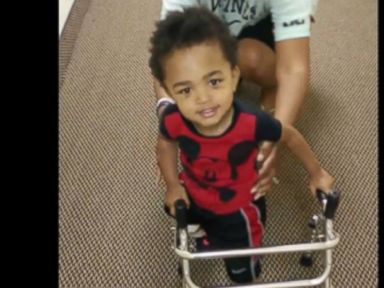 Watch 2-Year-Old Amputee Take First Steps